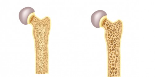 Recognizing The Early Warning Signs Of Osteoporosis